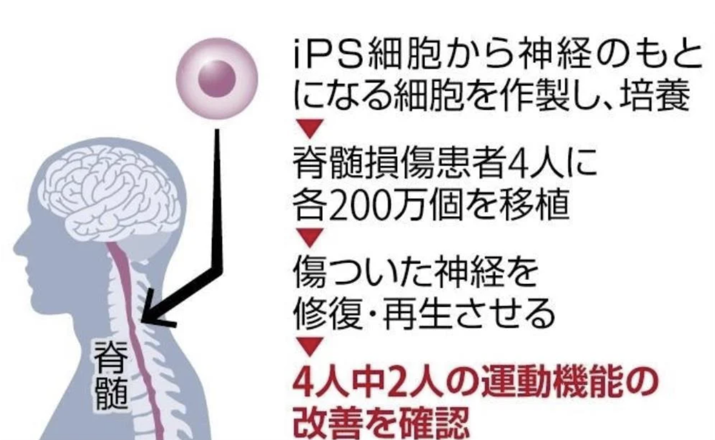 世界首例：两名患者在 iPS 细胞移植后运动功能改善